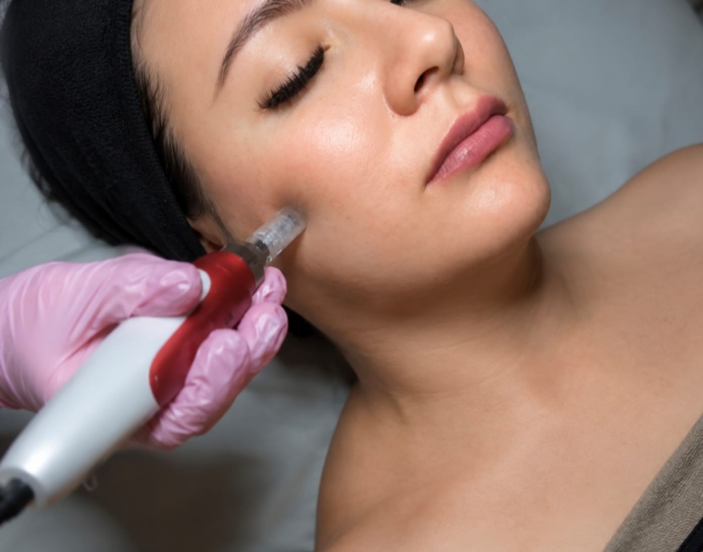 Microneedling en VILRIV SPA Guadalajara