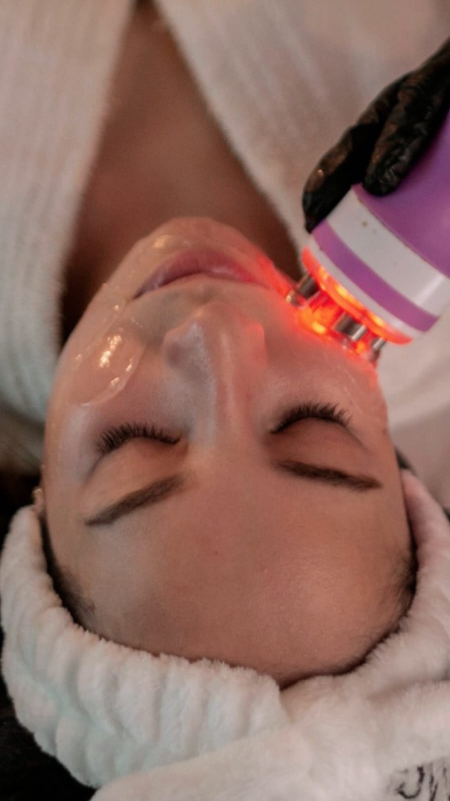 Radiofrecuencia Fraccionada en VILRIV SPA Guadalajara